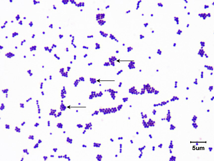 Staphylococcus aureus light microscopy. Morphology of Staphylococcus aureus  under the microscope. Micrograph of S.aureus, Gram stain. Gram-stained  smear from culture.