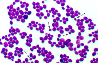 Direct stain of <i>Candida albicans</i>, taken using oil immersion microscopy, showing asexual reproduction by budding.