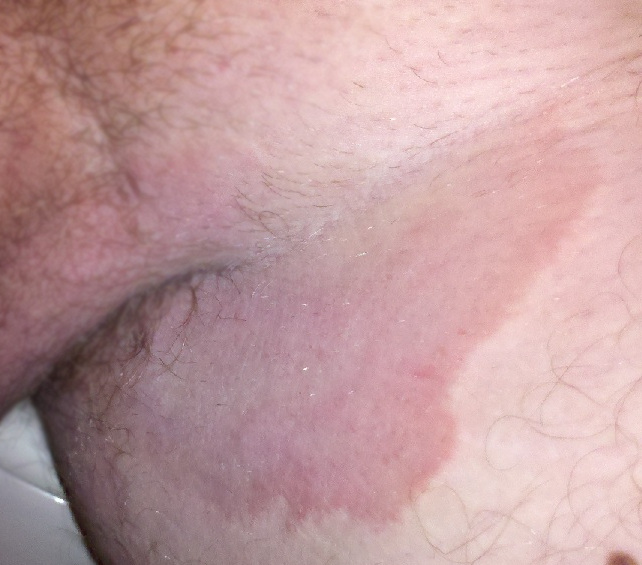 Photograph of tinea cruris.