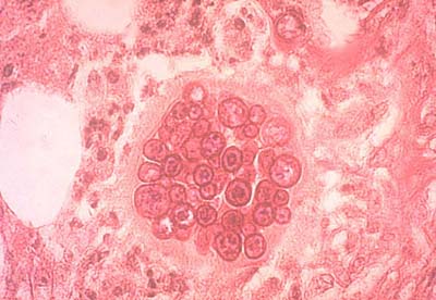 Photomicrograph showing an endosporulating spherule of <I>Coccidioides immitis</i> in the lung of an infected person.