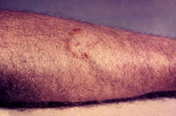 Photograph of tinea corporis.