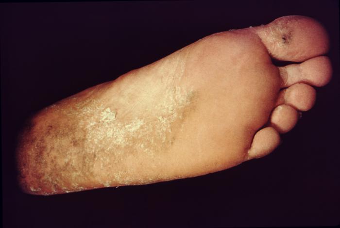 Photograph of tinea pedis.