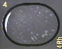 Photograph of a positive serologic test for <i>Shigella</i> showing clumping of the bacteria.