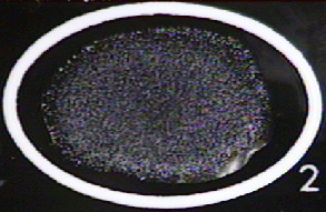 Photograph of a positive qualitative serologic 
    test for SLE showing clumping of the latex particles.