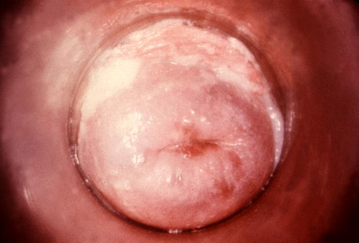 Photograph of <em>Candida albicans</em> growing in the cervix.