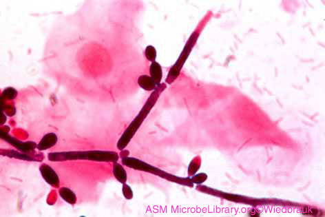 Photomicrograph of a vaginal smear of a person 
		  with <em>Candida</em> vaginitis showing <i>Candida</i> in its hyphal form.