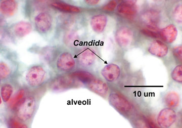 Photomicrograph of lung tissue infected with 
      <i>Candida albicans</i> showing yeast cells.