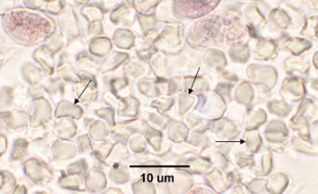 Photomicrograph of cysts of <i>Pneumocystis
    jiroveci</i> in a smear from bronchoalveolar lLavage.